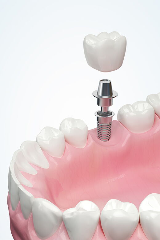 Zahnersatz und Implantate